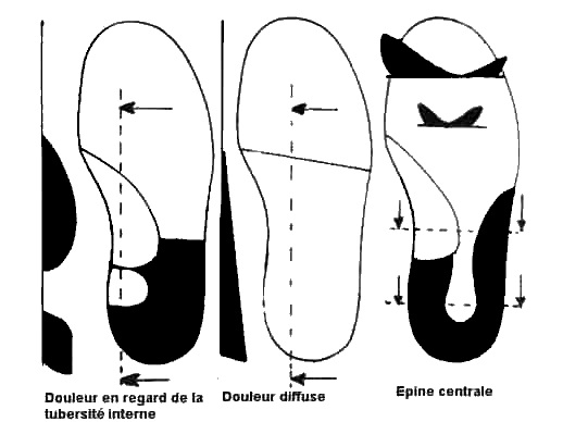 traitement d'une épine calcanéenne